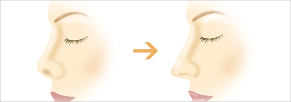 鼻中隔延長施術イメージ