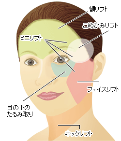 フェイスリフト適応部位