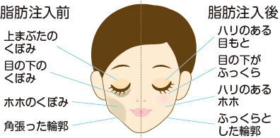 脂肪注入前後比較