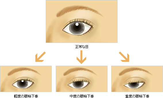 眼瞼下垂の症状