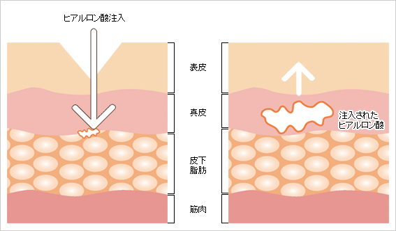 注入されたヒアルロン酸