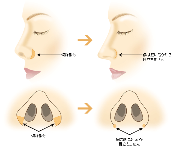 切除部分