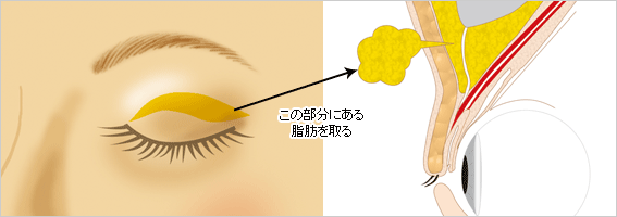 脂肪を取り除く