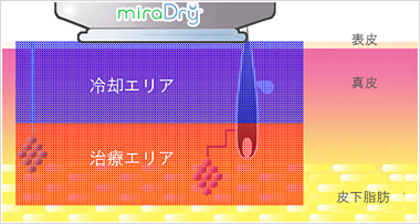 冷却システムで皮膚を保護