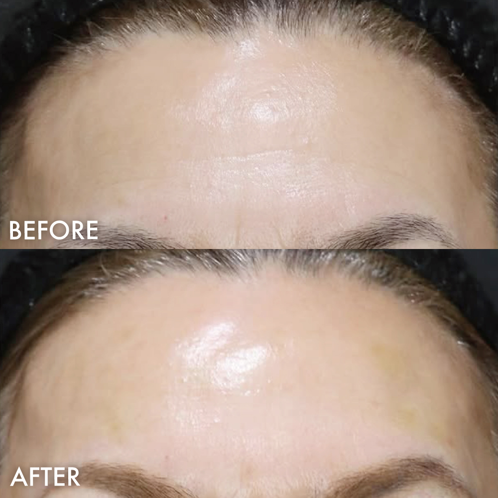 CGスタイラー症例