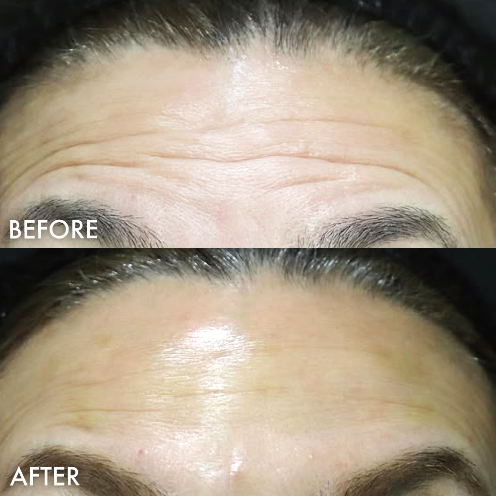 CGスタイラー症例