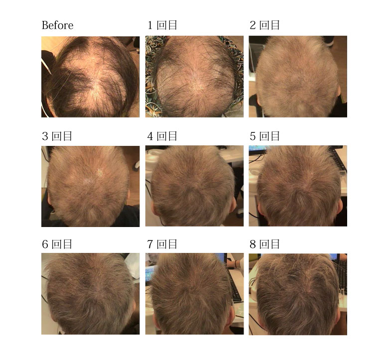 ヘアフィラー症例写真