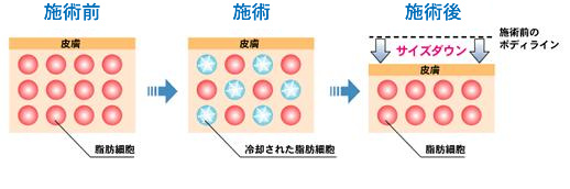 クリスタルの治療ステップ