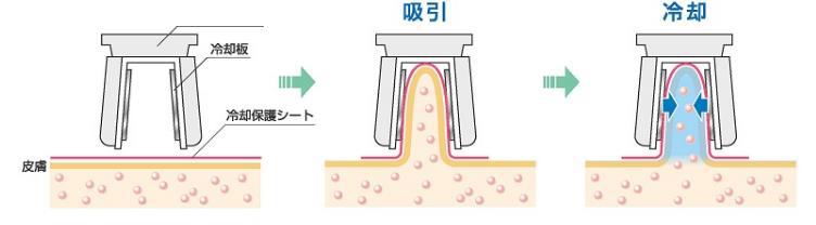 アプリケータで脂肪吸引・冷却