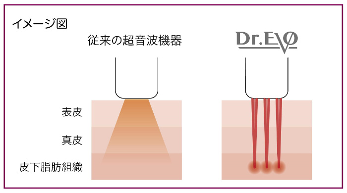 ドクターエボと従来の超音波機器比較