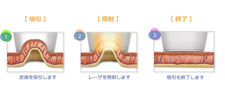 >吸引してレーザー光を照射するイメージ