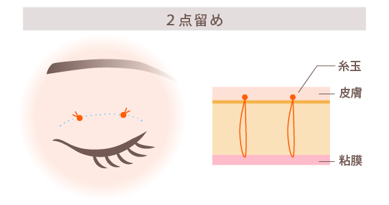 挙筋法2点留め