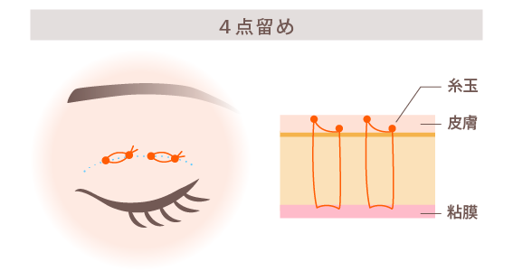 挙筋法4点留め