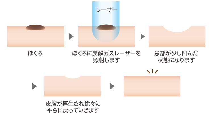 フラクショナル炭酸ガスレーザーほくろ除去イメージ