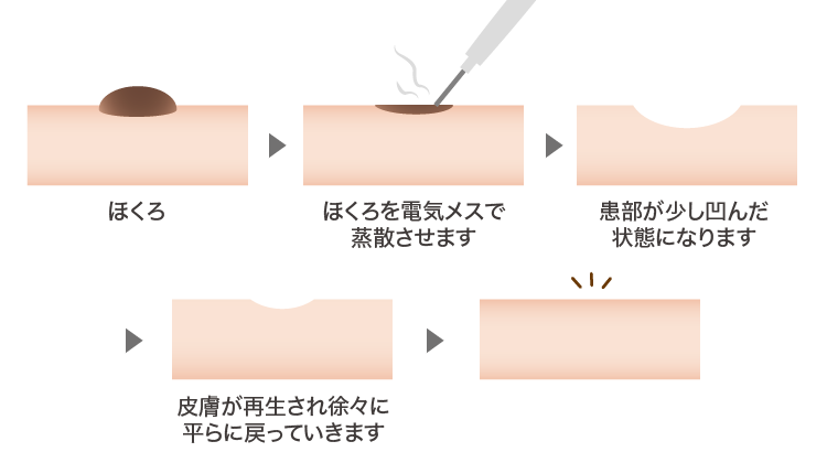 電気メスほくろ除去イメージ