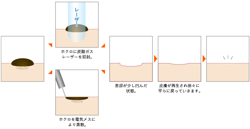 ほくろ除去イメージ