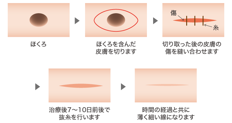 切縫ほくろ除去イメージ