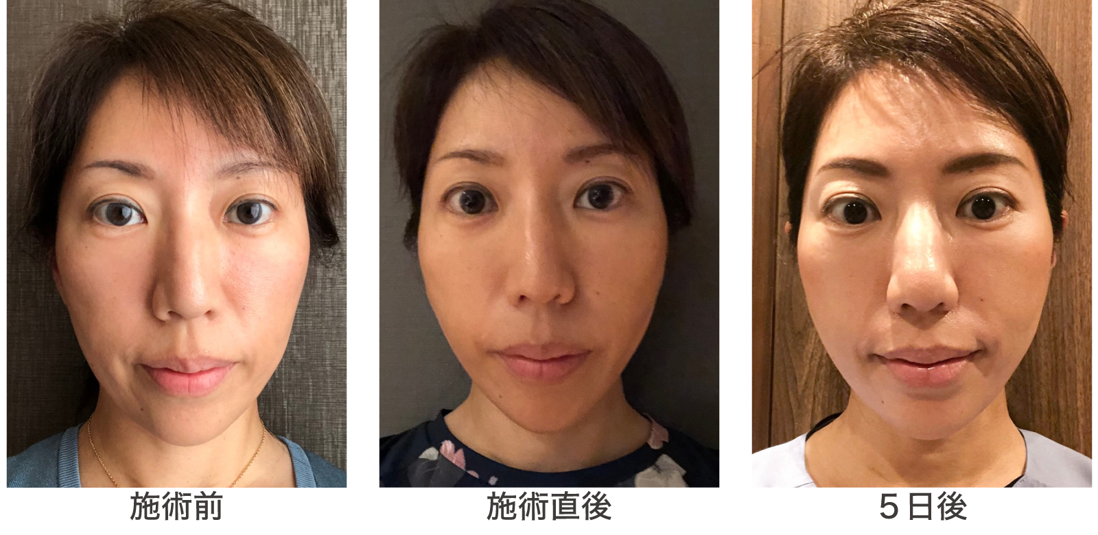 MWデュアルリフト®の症例