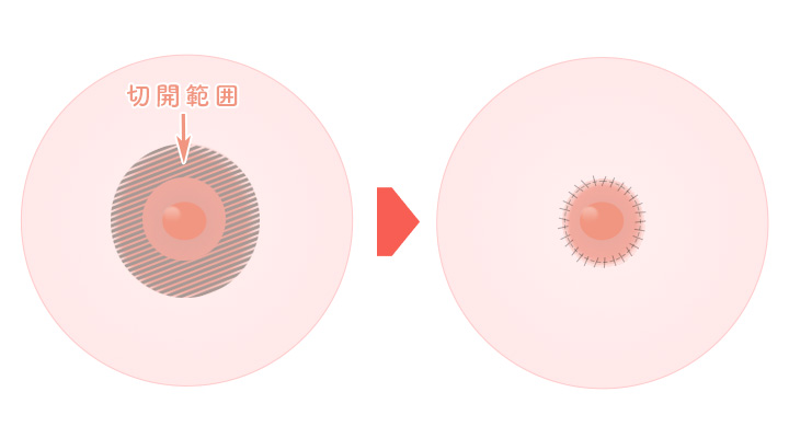 乳輪が極端に大きい方