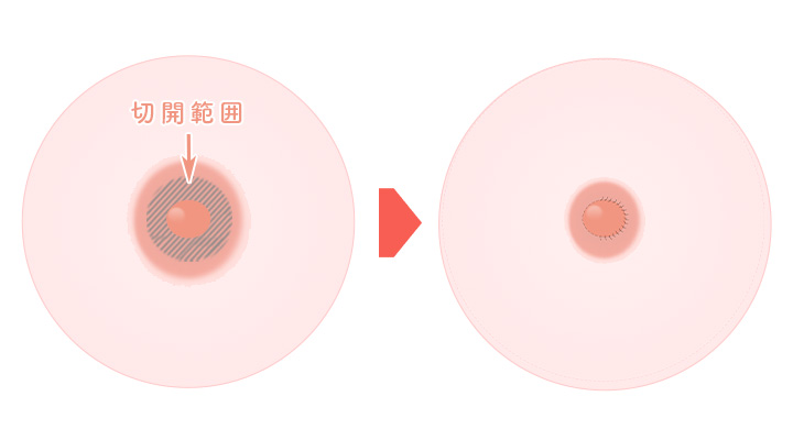 乳輪が極端に大きい方