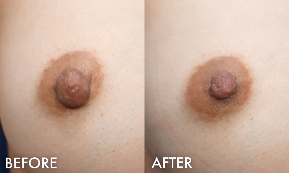乳頭縮小症例