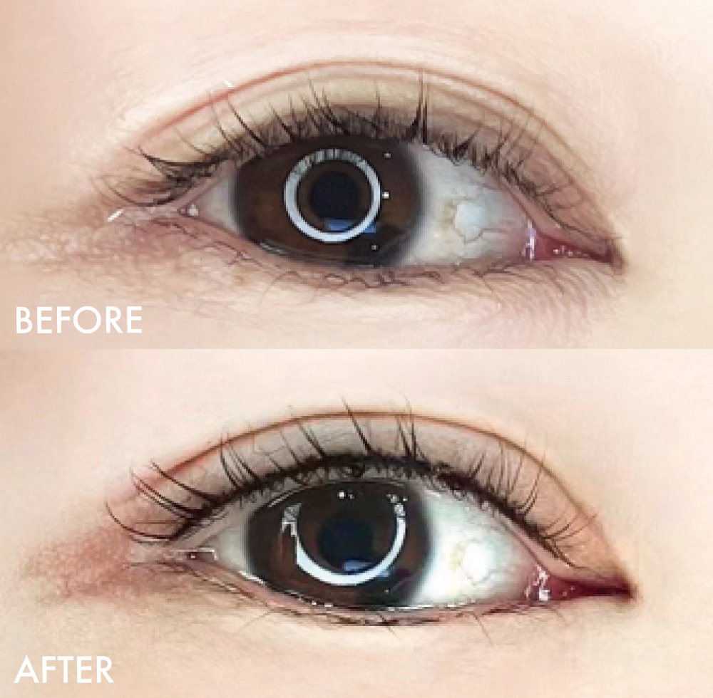 アイラインアートメイク症例