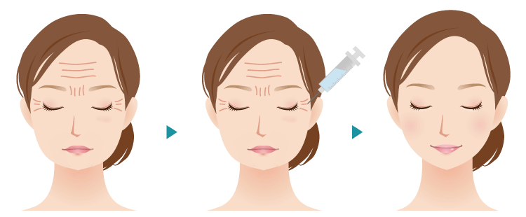 ボトックス注射