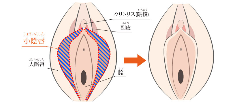 しょういんしん縮小手術 小陰唇縮小術｜婦人科形成なら湘南美容クリニック【公式】