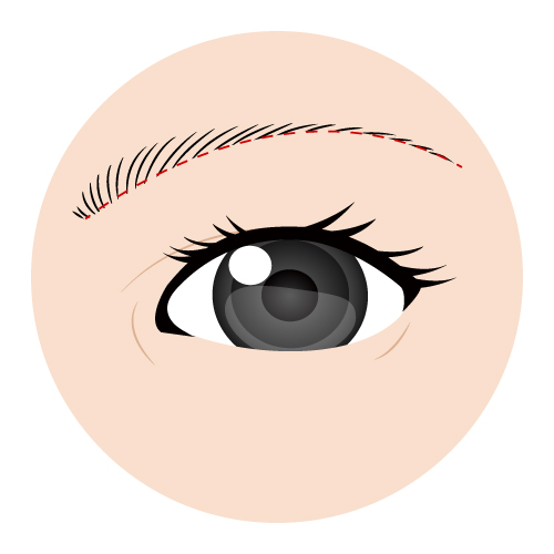 眉毛下切開（眉下切開）施術手順③